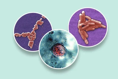 Cyclosporiasis vs other GI illnesses: Key differences explained