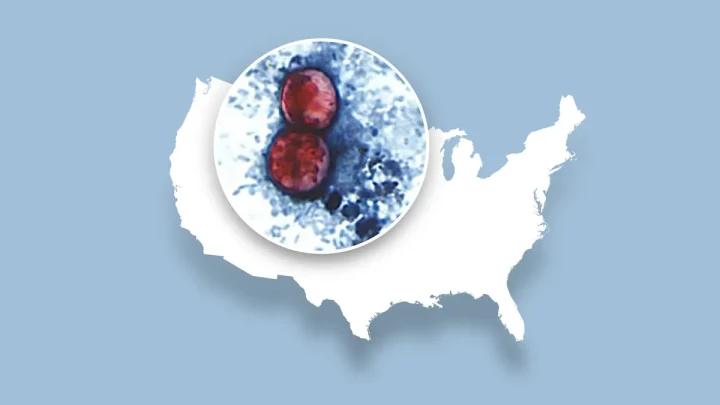 Latest updated map tracking ‘explosive diarrhea’ cases in the US